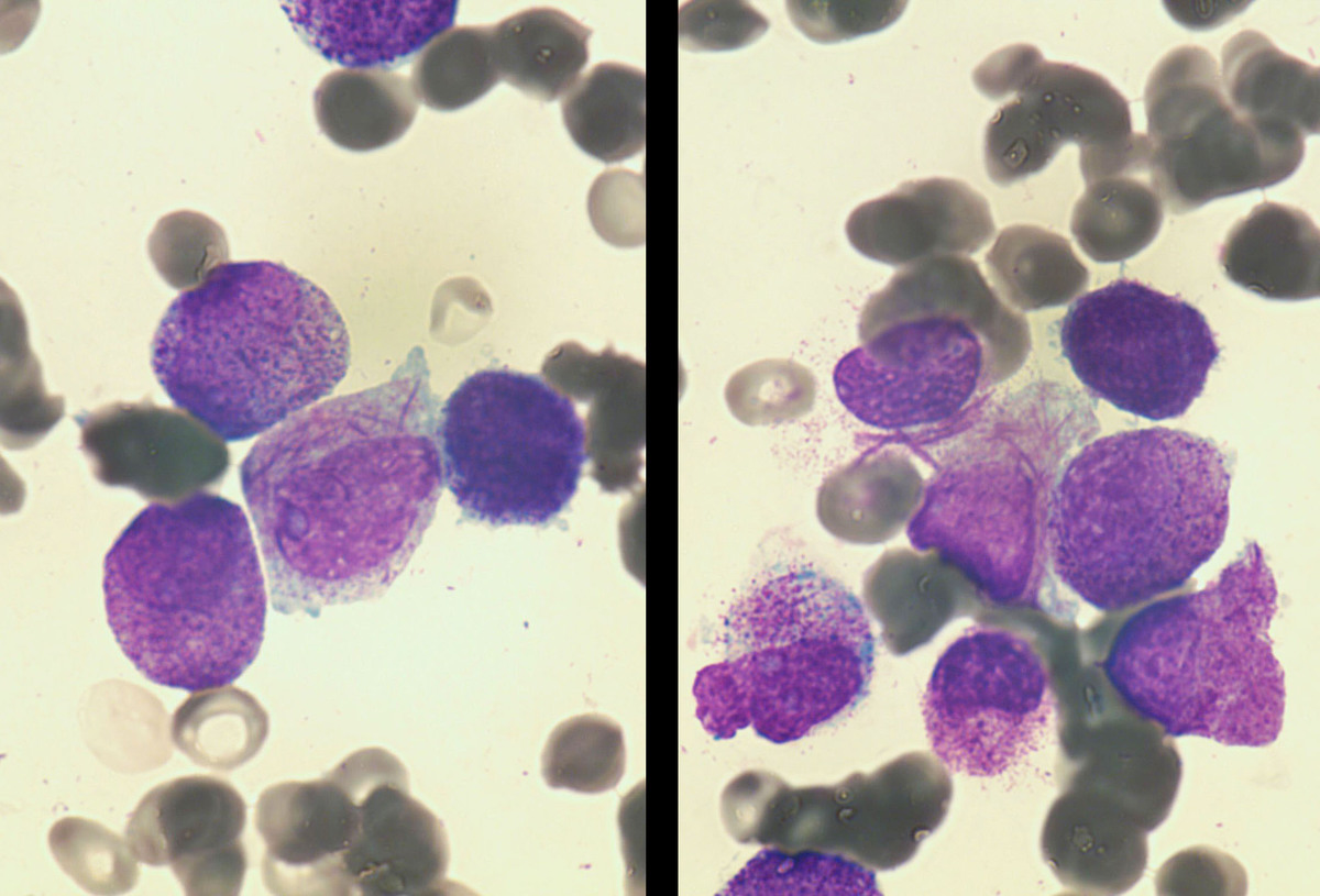 Many promyelocytes with Auer rods contained several, in aggregates, and occasionally spilling out of the cell.